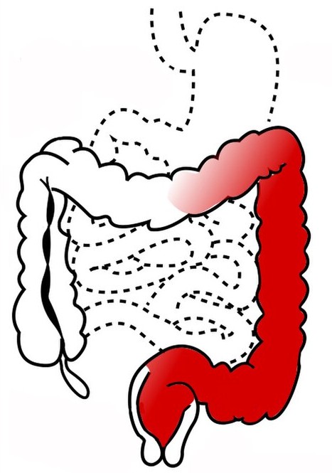 Imagen de cabecera para el artículo sobre la colitis ulcerativa, que muestra las áreas anatómicas que afecta esta patología